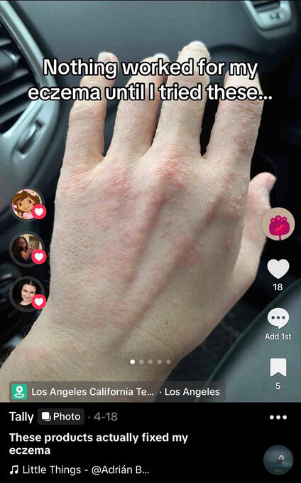 Eczema Swipe File Eczema Swipe File